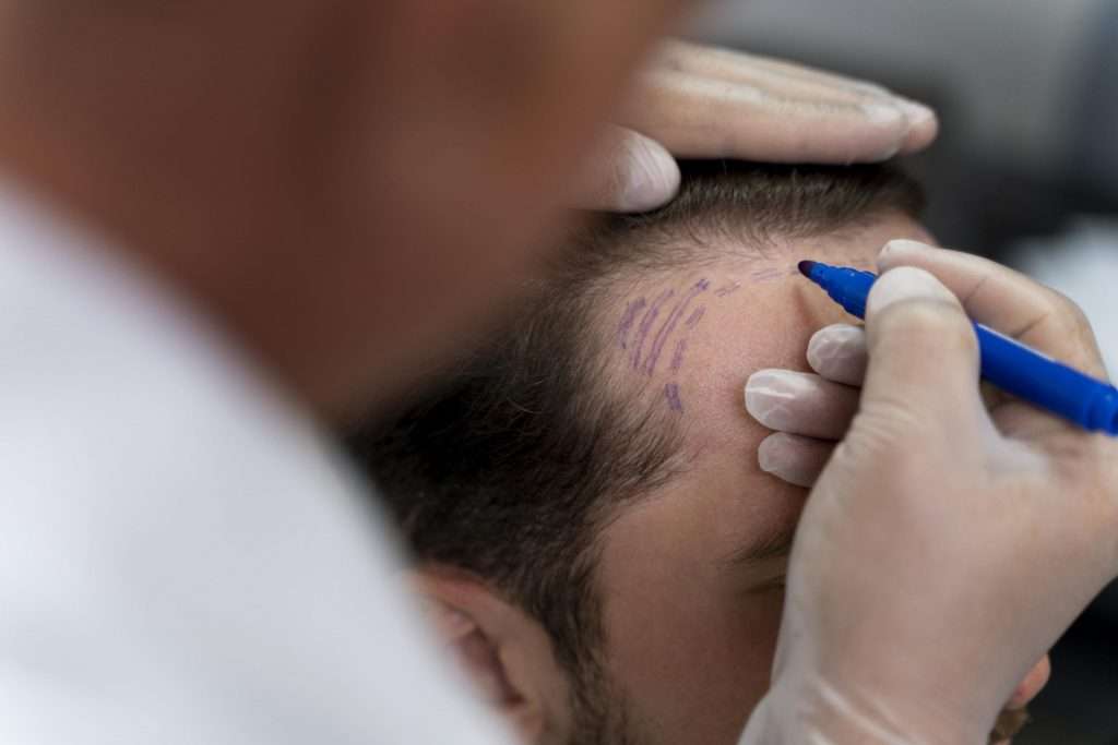 Tráfego Pago para Cirurgião Plástico de Transplante Capilar