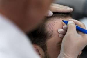 Tráfego Pago para Cirurgião Plástico de Transplante Capilar